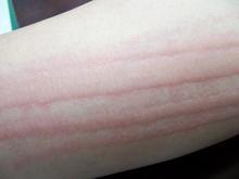 ݡ����֢״ͼƬ