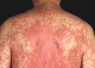 Ƥ����������֢״