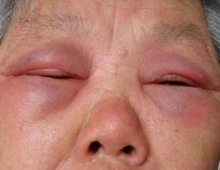 �����Թ���֢״