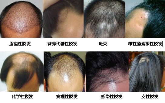 脱发的常见症状表现