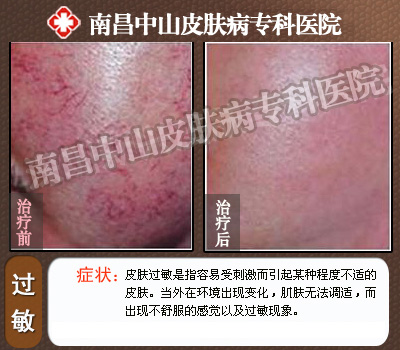 Ƥ����������ǰ��Ա�