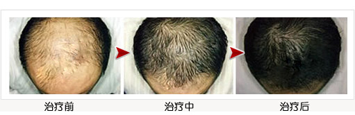 脱发治疗变化过程