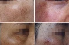 黄褐斑的几种常见症状表现