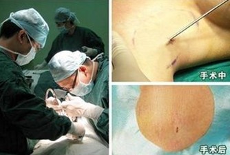 纳米微创手术治疗腋臭