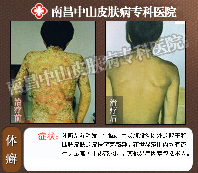 南昌中山皮肤病医院体癣治疗前后对比