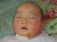 儿童湿疹症状