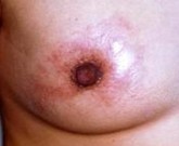 乳房湿疹症状