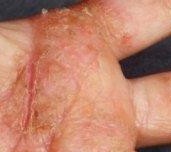 皲裂性湿疹症状