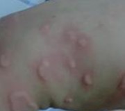 风热型荨麻疹症状