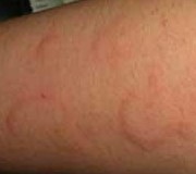 风寒型荨麻疹症状