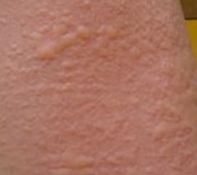 物质过敏型荨麻疹症状