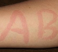 压力性荨麻疹症状