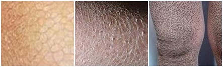 鱼鳞病的常见症状