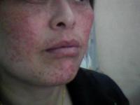 ��ƽ���֢״