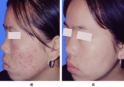 ³ÂС½ãÀ´ÎÒÔºÖÎÁÆÇ°ºó¶Ô±È