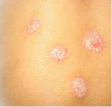 ��ɽר�ҽ��ţƤѢ�᲻�ᴫȾ