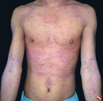 ����Ƥ�״�Ⱦ��