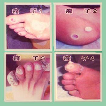 Ѱ�����֢״