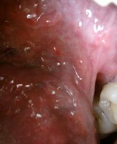 ���������ʪ����ʲôҩ�� ���������ʪ���ҩ������Щ