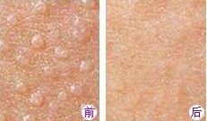 寻常疣治疗对比