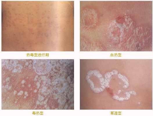 Ѱ����ţƤѢ����Щ֢״