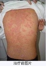 �ϲ�ţƤѢ����ҽԺר�ҽ�����Σ����ʲô