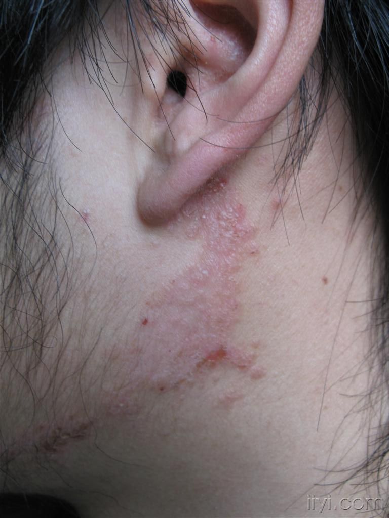 Ƥ��ʪ��Ӧ����ô���ƣ�