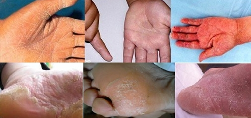 手足癣症状