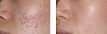 痤疮治疗前后对比