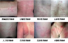 ��ͬ���͵�ݡ�������ʲô֢״