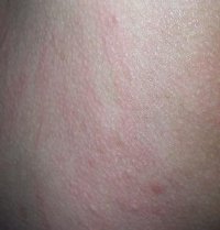 ������Ƥ�׵�ע��������ʲô