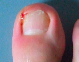 单纯性甲沟炎.jpg