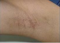 祛腋臭成功案例图