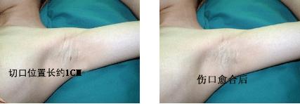 腋臭手术前后疤痕