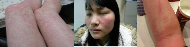 Ƥ��������֢״,������Ƥ������