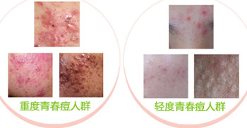 ²»Í¬³Ì¶ÈÇà´º¶»Ö¢×´±íÏÖ