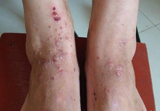 �ȽŲ�ʪ��֢״�������ļ�����