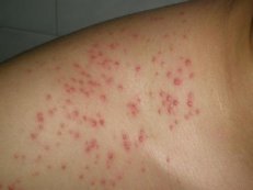 ����ë�ܽǻ���õ�ҽԺ���ļң�