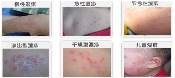 �ֲ�ʪ��֢״