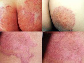 �ϲ���ɽƤ����ҽԺ��Ѣ����ǰ��Ա�