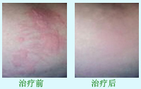 荨麻疹的治疗前后的对比图
